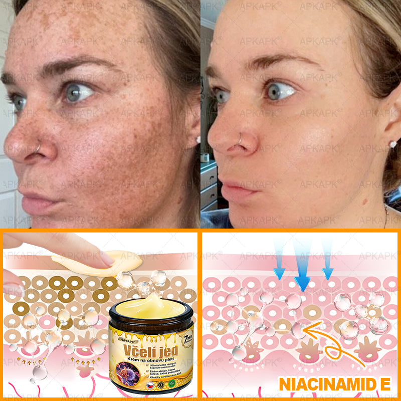 𝖠𝖯𝖪𝖠𝖯𝖪® 🐝 Krém s včelím jedem na obnovu pokožky 🐝 pomáhá při řešení kožních problémů, jako jsou: vrásky, jizvy, pigmentové skvrny, strie, akné, lupénka, ekzém, kožní léze, podráždění, záněty a další kožní potíže.